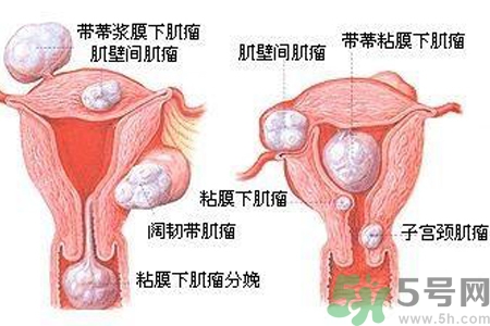 ?子宮移位怎么治療？子宮移位能懷孕嗎？
