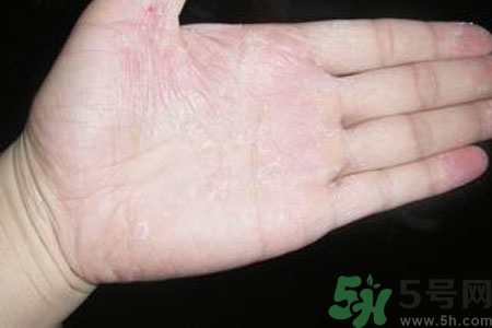 ?手掌脫皮的危害有哪些？如何預(yù)防手掌脫皮？