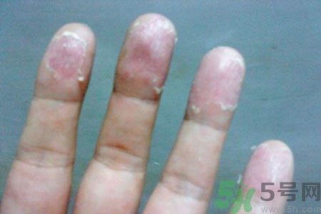 ?手掌脫皮的危害有哪些？如何預(yù)防手掌脫皮？