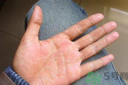?手掌脫皮的危害有哪些？如何預(yù)防手掌脫皮？