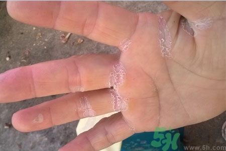 手脫皮是什么原因？手脫皮的治療方法是什么？