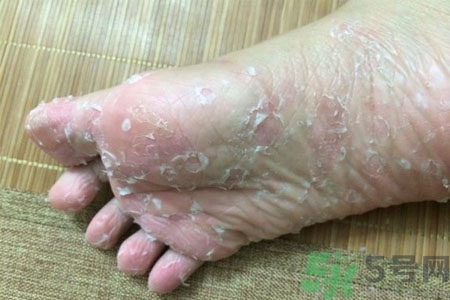 腳脫皮是怎么回事？腳脫皮怎么辦？