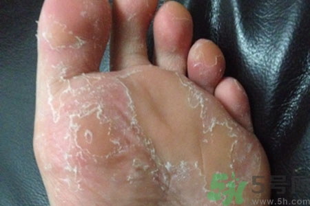 腳脫皮是怎么回事？腳脫皮怎么辦？