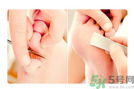 雞眼怎么能徹底根治？如何預(yù)防腳上長(zhǎng)雞眼？