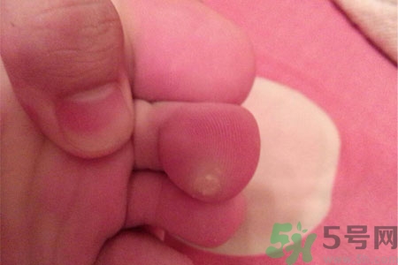 雞眼怎么能徹底根治？如何預防腳上長雞眼？