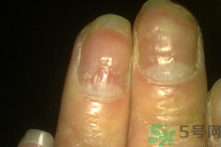 孩子手指甲凹凸不平是什么原因？手指甲凹凸不平的原因是什么？