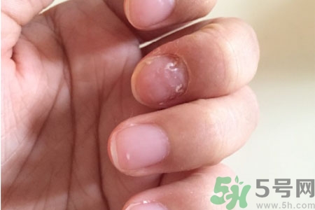 孩子手指甲凹凸不平是什么原因？手指甲凹凸不平的原因是什么？