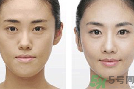 激光縮毛孔多少錢一次？激光縮毛孔一個療程多少錢？