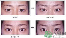 提眉術(shù)后多久可以恢復(fù)？提眉術(shù)后全過程照片