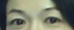 提眉術(shù)后多久可以恢復(fù)？提眉術(shù)后全過程照片