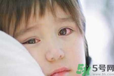 流行性腮腺炎的表現(xiàn)有哪些？?流行性腮腺炎飲食怎么調(diào)理？