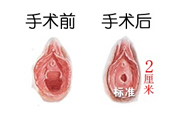 處女膜修補術(shù)效果怎么樣？處女膜修復(fù)手術(shù)有風(fēng)險嗎？