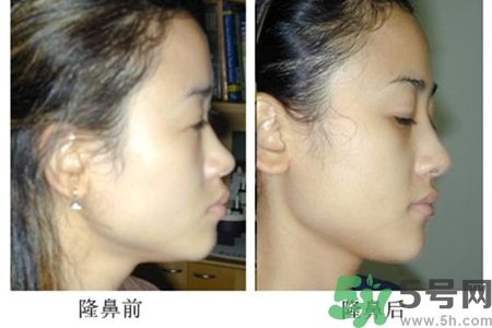 玻尿酸隆鼻的危害有哪些？玻尿酸隆鼻的副作用是什么？