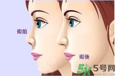 玻尿酸隆鼻的缺點(diǎn)是什么？玻尿酸隆鼻的優(yōu)點(diǎn)有哪些？