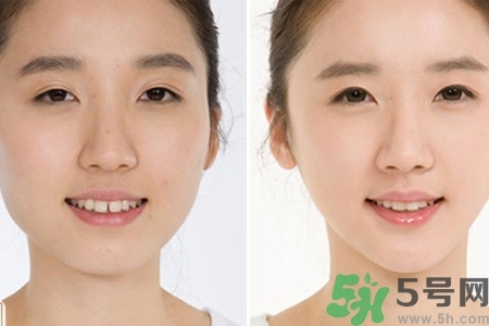 玻尿酸隆鼻的缺點(diǎn)是什么？玻尿酸隆鼻的優(yōu)點(diǎn)有哪些？