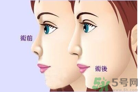 玻尿酸隆鼻和手術(shù)隆鼻的區(qū)別是什么？