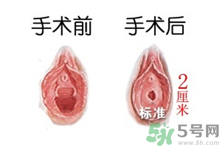 處女膜修補(bǔ)術(shù)效果怎么樣？處女膜修復(fù)手術(shù)有風(fēng)險(xiǎn)嗎？