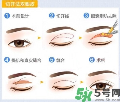 雙眼皮手術(shù)哪種最好？割雙眼皮后注意些什么？