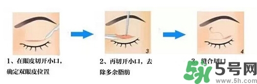 雙眼皮手術(shù)哪種最好？割雙眼皮后注意些什么？