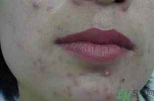 什么樣的痘痘能擠？哪些痘痘不能擠？
