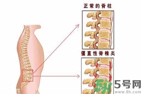 僵直性脊椎炎的癥狀有哪些？怎樣預防僵直性脊椎炎？