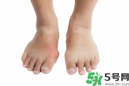 引發(fā)痛風的原因是什么？痛風病人飲食需注意什么好？