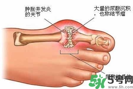 引發(fā)痛風的原因是什么？痛風病人飲食需注意什么好？