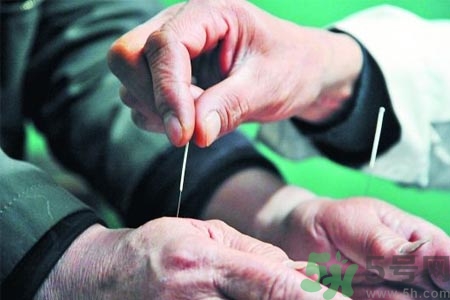 針灸一次要扎多長時間？針灸可以幾天做一次？