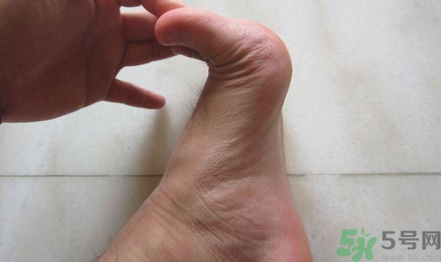腳拇指外翻遺傳嗎？腳拇指外翻怎么矯正？