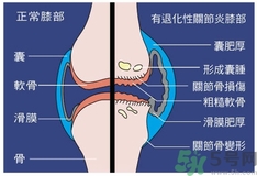 骨關(guān)節(jié)炎能治好嗎？骨關(guān)節(jié)炎平時(shí)注意事項(xiàng)