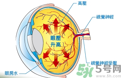 青光眼可以治愈嗎？青光眼怎樣治療？