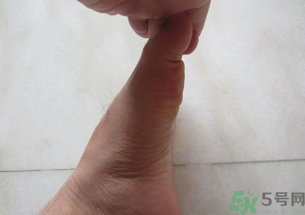 腳拇指外翻遺傳嗎？腳拇指外翻怎么矯正？