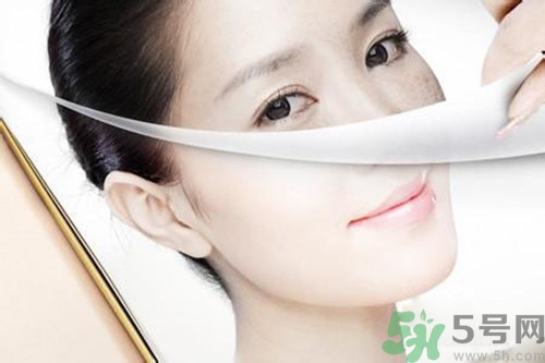 曬斑可以自己消退嗎？曬斑可以用激光去除嗎？