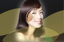 曬斑可以自己消退嗎？曬斑可以用激光去除嗎？