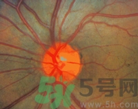 青光眼可以治愈嗎？青光眼怎樣治療？