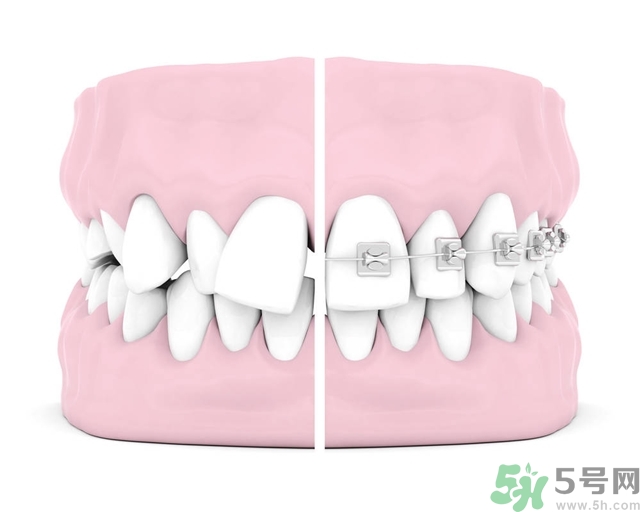 牙齒橫著長(zhǎng)怎么辦？智齒橫著長(zhǎng)一定要拔嗎？