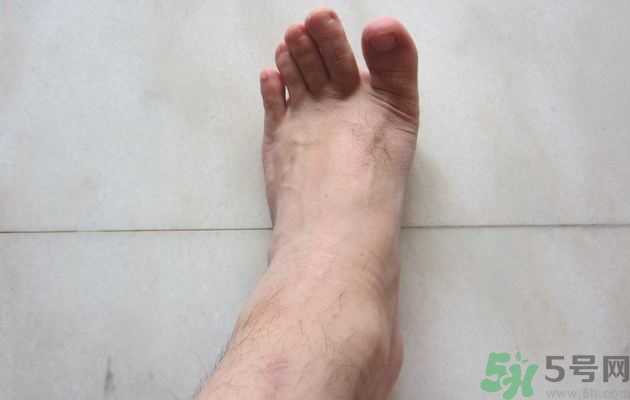 腳拇指外翻遺傳嗎？腳拇指外翻怎么矯正？