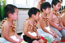 小孩可以拔罐嗎？寶寶能拔火罐嗎？