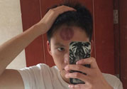 頭痛可以在額頭上拔火罐嗎？額頭上拔火罐有什么好處？