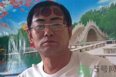 頭痛可以在額頭上拔火罐嗎？額頭上拔火罐有什么好處？