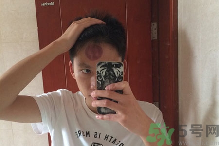頭痛可以在額頭上拔火罐嗎？額頭上拔火罐有什么好處？