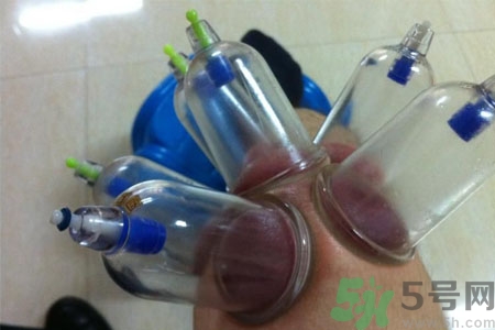 膝蓋能拔罐嗎？膝蓋疼可以拔罐嗎？