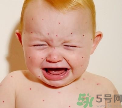 新生兒濕疹怎么引起的？新生兒濕疹如何處理？