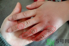 生凍瘡癢怎么辦？生凍瘡很癢的時(shí)候怎么辦？