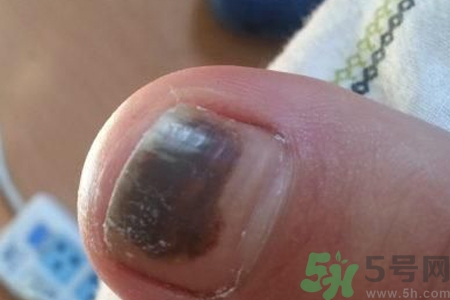 腳趾甲變黑是什么原因？腳趾甲變黑是怎么回事？