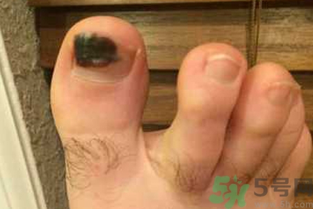腳趾甲變黑是什么原因？腳趾甲變黑是怎么回事？