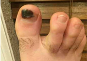 腳趾甲變黑是什么原因？腳趾甲變黑是怎么回事？