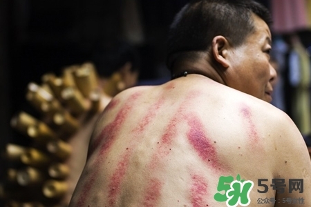 背部刮痧后能拔火罐嗎？背部刮痧后拔火罐有什么好處？