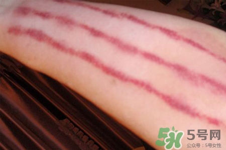 揪痧和刮痧哪個(gè)效果比較好？揪痧和刮痧的區(qū)別？