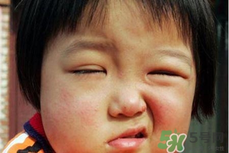 面癱能針灸嗎？針灸能治療面癱嗎？